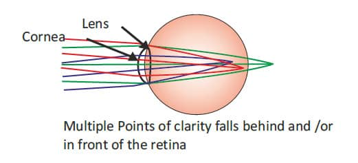 Astigmatism
