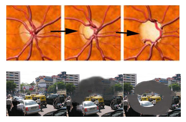 Glaucoma