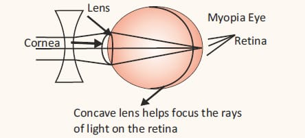 Refractive errors