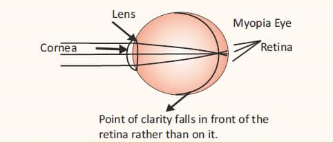 Refractive errors