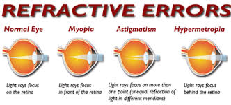 Refractive Errors