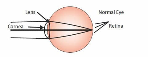 Refractive errors